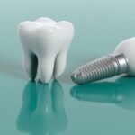 Dental Implants in Turkey: Everything You Need to Know